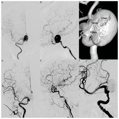 Case report: Covered stent placement to treat delayed aneurysmal rupture after flow diverter-assisted coil embolization